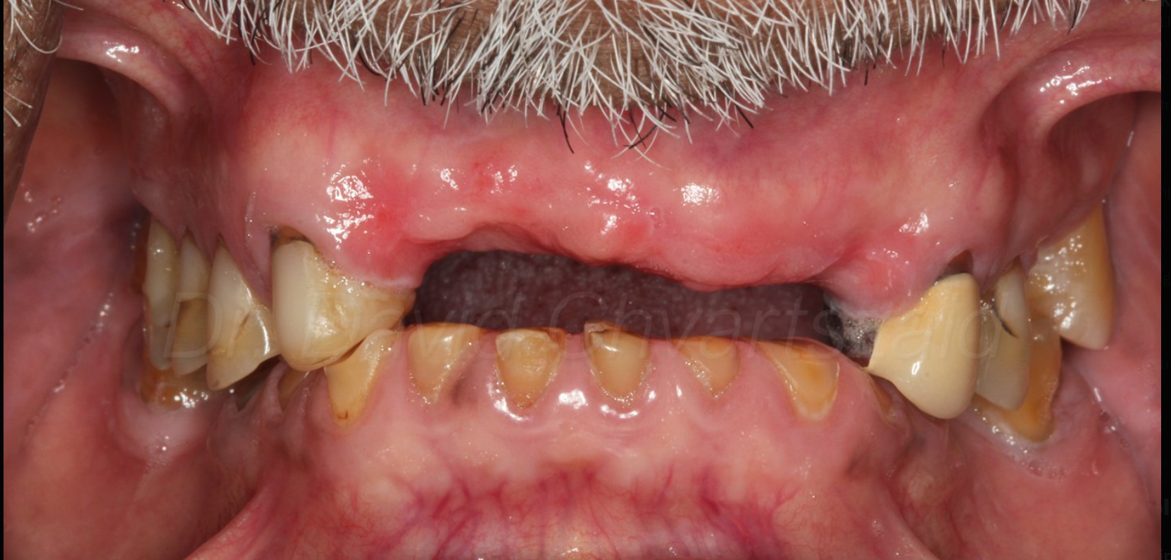 Mouth with terrible, neglected teeth